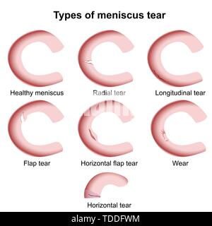 Lesioni del menisco medical illustrazione vettoriale isolati su sfondo bianco, lacerazione del menisco Illustrazione Vettoriale