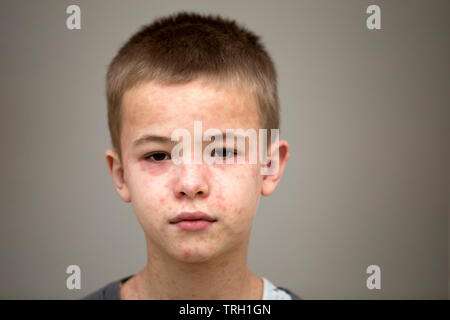Ritratto di malati triste bambino affette da morbillo o varicella con dossi su tutta la faccia. Contagiosa malattie del bambino e il trattamento. Foto Stock