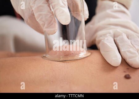 Close-up di medico donna di eseguire il massaggio Terapia cupping sul paziente presso la clinica medica Foto Stock