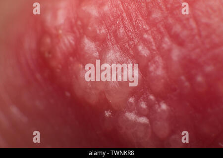 Inizio della coltivazione di herpes su caucasica uomo maschio sul lato anteriore di un labbro superiore super microscopio macro Foto Stock