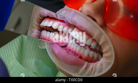 Dentista esamina lo stato dei denti della ganascia di una ragazza paziente. Vista laterale. Dental Clinic. Assistenza sanitaria. Foto Stock