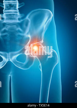 3D Rendering accurato dal punto di vista medico illustrazione di un doloroso hip joint Foto Stock