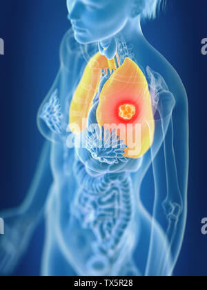 3D Rendering accurato dal punto di vista medico illustrazione di un femmine il cancro ai polmoni Foto Stock