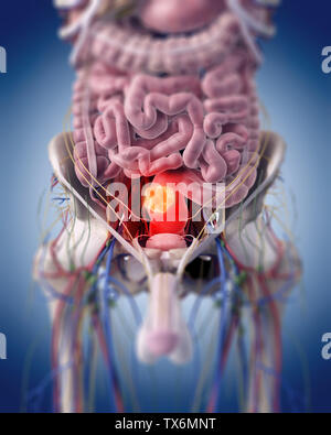 3D Rendering accurato dal punto di vista medico illustrazione di un tumore rettale Foto Stock