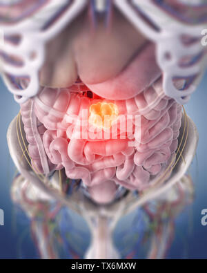 3D Rendering accurato dal punto di vista medico illustrazione di un tumore del colon Foto Stock