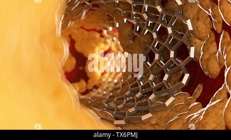 3D Rendering accurato dal punto di vista medico illustrazione di uno stent all'interno di una arteria grassi Foto Stock