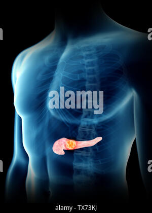3D Rendering accurato dal punto di vista medico illustrazione di un mans tumore del pancreas Foto Stock