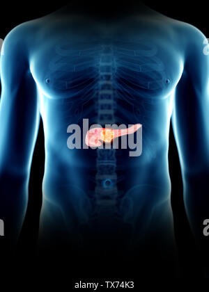 3D Rendering accurato dal punto di vista medico illustrazione di un mans tumore del pancreas Foto Stock