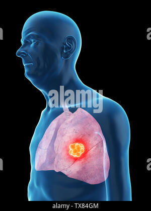 3D Rendering accurato dal punto di vista medico illustrazione di un vecchio mans il cancro ai polmoni Foto Stock