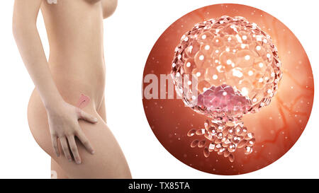 Donna incinta con utero visibile e impiantati bastocyst, Foto Stock