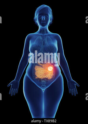 3D Rendering accurato dal punto di vista medico illustrazione di un tumore in un womans intestino tenue Foto Stock