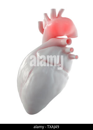 3D Rendering accurato dal punto di vista medico illustrazione di un aneurisma aortico Foto Stock
