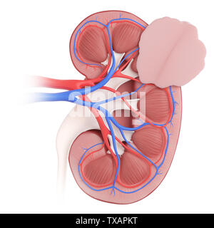 3D Rendering accurato dal punto di vista medico illustrazione del cancro del rene Foto Stock