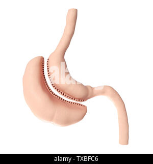 3D Rendering accurato dal punto di vista medico illustrazione di un cannotto verticale gastrectomia Foto Stock