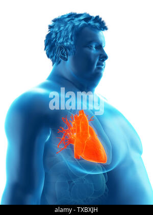 3D Rendering accurato dal punto di vista medico illustrazione di un obeso mans cuore Foto Stock