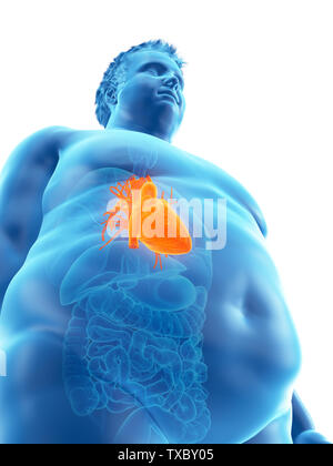 3D Rendering accurato dal punto di vista medico illustrazione di un obeso mans cuore Foto Stock