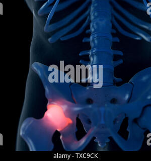 3D Rendering accurato dal punto di vista medico illustrazione di un doloroso hip joint Foto Stock