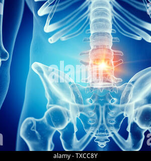 3D Rendering accurato dal punto di vista medico illustrazione di dolori alla parte inferiore della schiena Foto Stock