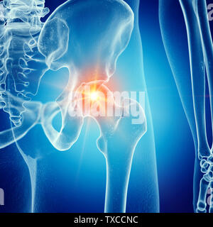 3D Rendering accurato dal punto di vista medico illustrazione di un doloroso hip joint Foto Stock