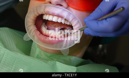 Dentista esamina lo stato dei denti, con l aiuto di specchio dentale nel paziente della ragazza. Dental Clinic. Assistenza sanitaria. Foto Stock