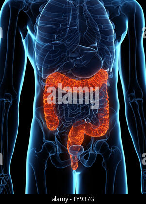 3D Rendering accurato dal punto di vista medico illustrazione di un colon malato Foto Stock