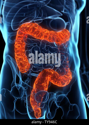 3D Rendering accurato dal punto di vista medico illustrazione di un colon malato Foto Stock