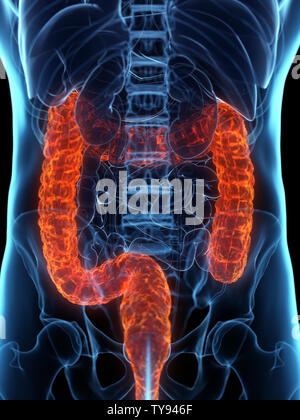 3D Rendering accurato dal punto di vista medico illustrazione di un colon malato Foto Stock