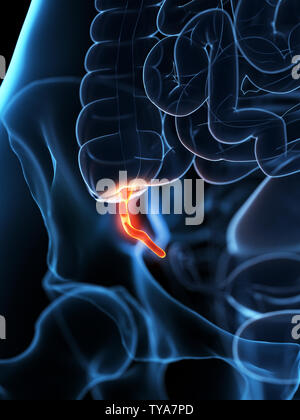 3D Rendering accurato dal punto di vista medico illustrazione di un appendice infiammata Foto Stock