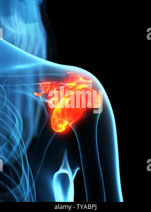 3D Rendering accurato dal punto di vista medico illustrazione dei legamenti infiammati Foto Stock