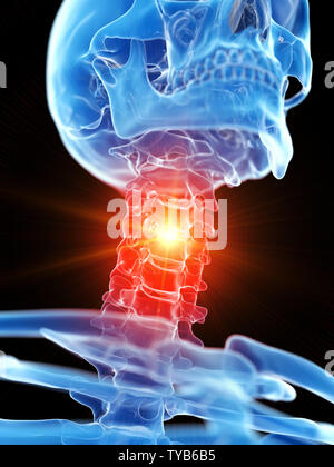 3D Rendering accurato dal punto di vista medico illustrazione della cervicale collo mostranti dolore Foto Stock