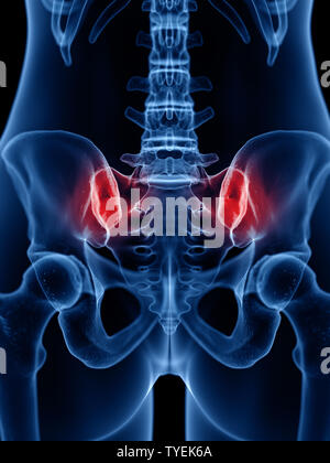 3D Rendering accurato dal punto di vista medico illustrazione di un doloroso sacroiliac joint Foto Stock