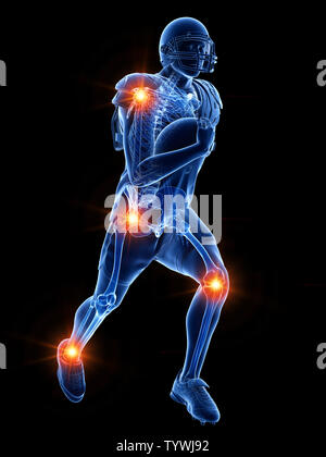 3D Rendering accurato dal punto di vista medico illustrazione dello scheletro di un giocatore di football americano avente giunti doloroso Foto Stock
