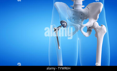 3D Rendering accurato dal punto di vista medico illustrazione di un'anca Foto Stock