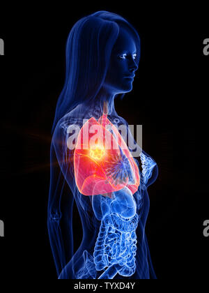 3D Rendering accurato dal punto di vista medico illustrazione di un womans tumore ai polmoni Foto Stock