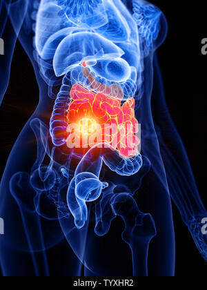 3D Rendering accurato dal punto di vista medico illustrazione di un womans intestino tenue tumore Foto Stock