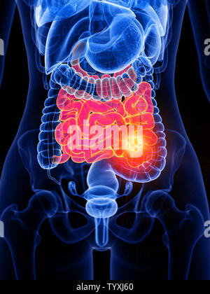 3D Rendering accurato dal punto di vista medico illustrazione di un womans intestino tenue tumore Foto Stock