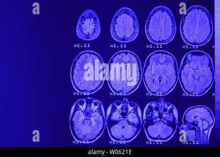 MRI del cervello su uno sfondo nero con retroilluminazione blu. Posto a sinistra per la pubblicità di iscrizione Foto Stock