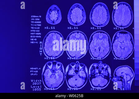 MRI scan o immagini a risonanza magnetica della testa e del cervello scansione. Il risultato è un MRI del cervello con i valori e i numeri con retroilluminazione blu. Foto Stock