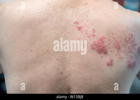 Le assicelle (malattia), herpes zoster, virus varicella-zoster. eruzioni cutanee e vesciche sulla scocca Foto Stock