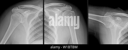 X-ray serie di un uomo giunto a spalla che mostra l'osso dell'omero del braccio superiore, la clavicola (collare osso), scapolare (spalla) e la gabbia toracica. Foto Stock