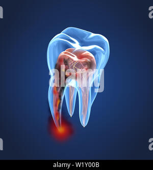 Denti danneggiati vista a raggi x. Accurata dal punto di vista medico dente 3D illustrazione Foto Stock