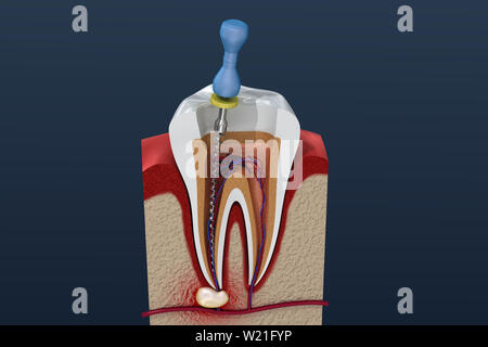 Trattamento canalare processo. 3D illustrazione Foto Stock