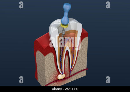 Trattamento canalare processo. 3D illustrazione Foto Stock