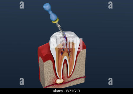 Trattamento canalare processo. 3D illustrazione Foto Stock