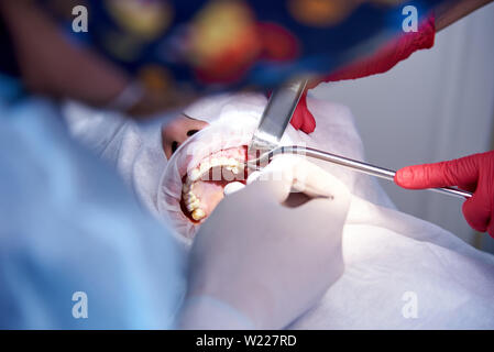 La chirurgia nella clinica dentale. Sinus operazione di sollevamento.Fase impianto dentale. Foto Stock