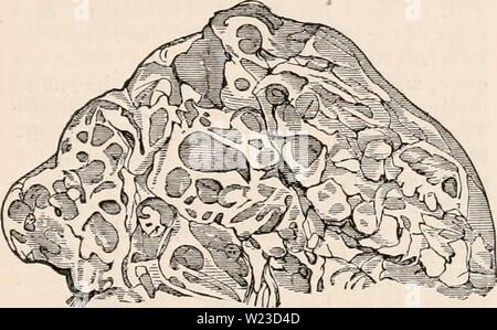 Immagine di archivio da pagina 154 della encyclopaedia - Wikizionario di anatomia e. Il encyclopaedia - Wikizionario di anatomia e fisiologia cyclopdiaofana0401todd Anno: 1847 prodotti, accidentale. 133 molti scrittori chirurgico confusi, sotto il nome di erronea del ' exostosis cartilaginei ' (erronea, se non per altra ragione, perché la formazione in questione può molla da altri tessuti di osso), con prodotti essenzialmente di carattere diverso e da alcuni altri autori hanno descritto come cancro di colloide. Quando intonso, enchondroma presenta se stesso come un tumore di dimensioni moderate e sferoidali di non-lobulated forma, racchiusi in cellular m Foto Stock