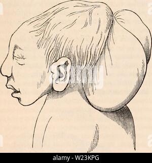 Immagine di archivio da pagina 171 della encyclopaedia - Wikizionario di anatomia e. Il encyclopaedia - Wikizionario di anatomia e fisiologia cyclopdiaofana0402todd Anno: 1849 956 TERATOLOGIA. un ernia. Le ossa parietali sono talvolta presenti, insieme con la superficie piana frontale di ossa e una perpendicolare osso occipitale, in modo che il vertice del cranio è piuttosto chiuso, ad eccezione di una piccola apertura. Fig. 609. mostra come il formato non valido di sostanza cerebrale è applicato per la medulla spinalis. Tutti i nervi cerebrali sono presenti. Questa forma di mostruosità ha in generale una minore brute-come aspetto; il tronco è più evoluta, e tutta la bo Foto Stock