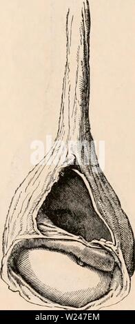 Immagine di archivio da pagina 212 della encyclopaedia - Wikizionario di anatomia e. Il encyclopaedia - Wikizionario di anatomia e fisiologia cyclopdiaofana0402todd Anno: 1849 testicolo (Anatomia anormale). 997 hydrocele, in cui il testicolo è trattenuto in addome o canale inguinale mentre il peritoneo, prolungata per una breve distanza nello scroto, forma la cisti contenente il fluido che è coperto soltanto dall'inte- guments e fascia superficiale. Encysted hydrocele del testicolo. - In questa forma di hydrocele, il fluido è effuso in un annuncio- ventitious cisti o cisti distinto dal sac della tunica vaginalis. La ciste Foto Stock