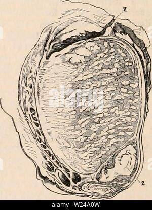 Immagine di archivio da pagina 221 della encyclopaedia - Wikizionario di anatomia e. Il encyclopaedia - Wikizionario di anatomia e fisiologia cyclopdiaofana0402todd Anno: 1849 diversi sono sparpagliati durante la tes- ticle, porzioni della ghiandola del suono di intervenire. In caso di malattie croniche e l' ampliamento di entrambi i testicoli prelevati da un paziente che è morto di ramollissement della medulla spinalis, ho trovato sei o sette distinti depositi di questo giallo in questione la sostanza del diritto testicolo, e un singolo solo nel corpo della sinistra. Le piccole masse come essi ingrandire coalescere, o l'unico aumenta, fino a quando tutto il testicolo pre Foto Stock