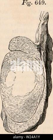 Immagine di archivio da pagina 221 della encyclopaedia - Wikizionario di anatomia e. Il encyclopaedia - Wikizionario di anatomia e fisiologia cyclopdiaofana0402todd Anno: 1849 testicolo (Anatomia anormale). 1006 epididimo, sembra impedire la oblitera- zione del condotto di cui esso è composto e quindi conti di atrofia che si verifica molto più raramente dopo consecutivi di orchidee che dopo l'infiammazione originari nel corpo del premistoppa, dove la delicata tubi seminale sono racchiusi nella ditta fermissimo tunica albuginea. Orcftitis cronica. - Il testicolo è soggetto a una forma di rigonfiamento infiammatorio di una distinta e cha cronica Foto Stock